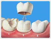 Dental Crowns