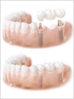 Dental Implants