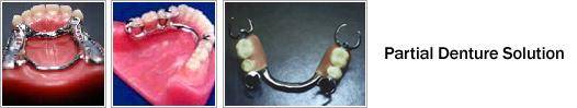 partial denture